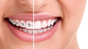 Orthodontic Treatment