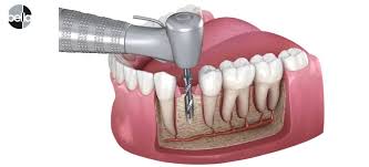Root Canal Treatment