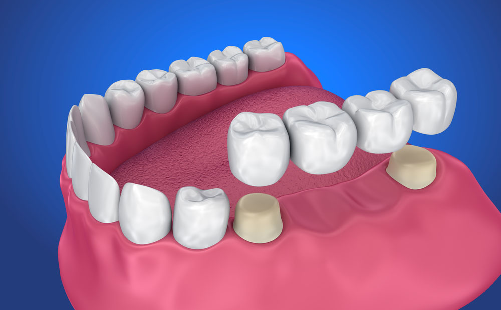 Dental Crowns and Bridges