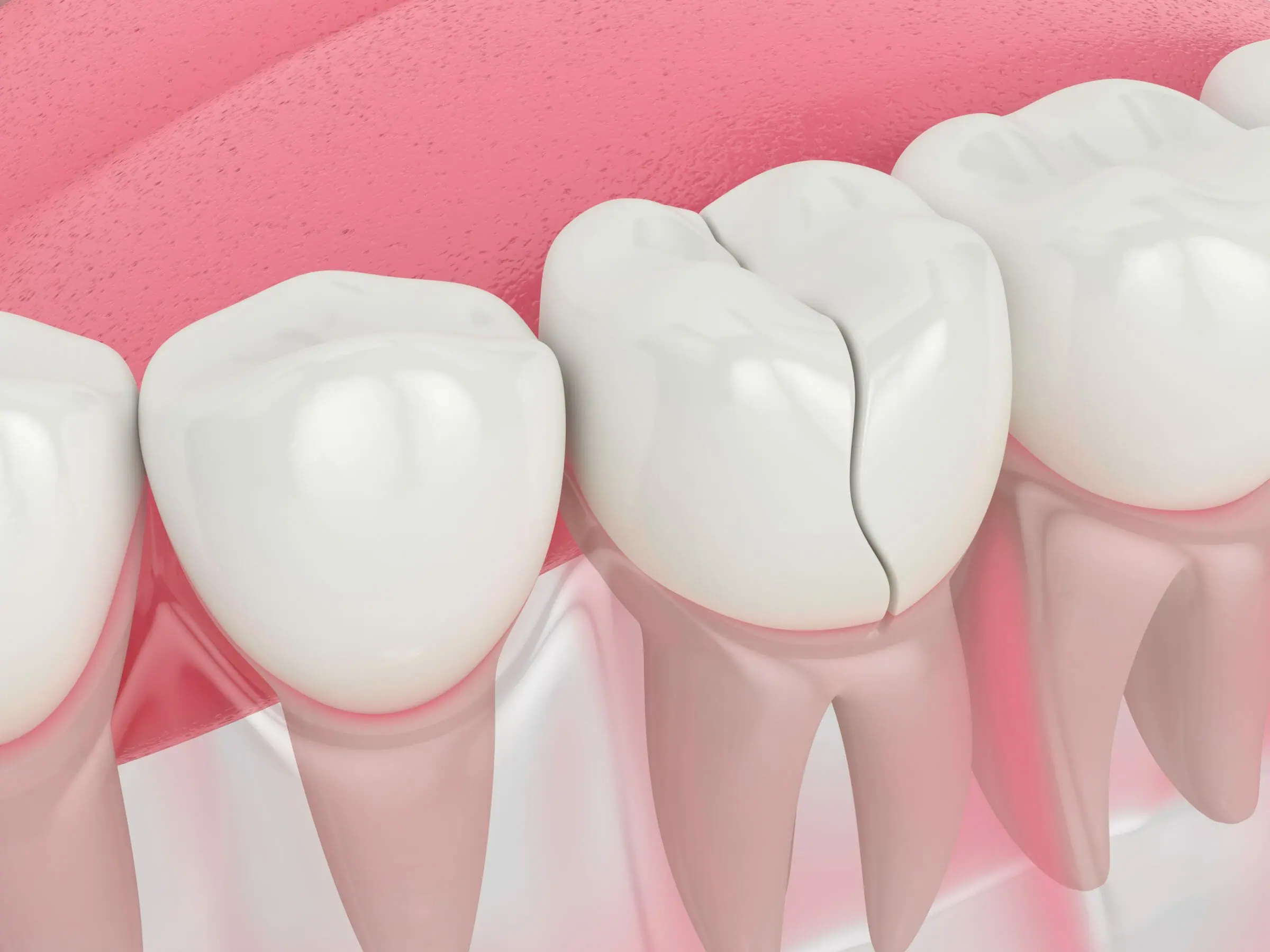 Dentures and Broken Tooth Repair